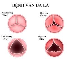 Hẹp van 3 lá - Hình ảnh minh họa